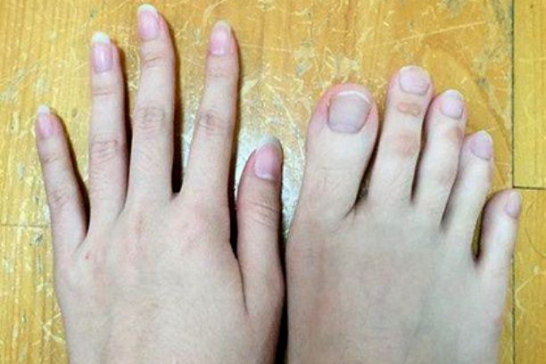 У жительницы Тайваня аномально длинные пальцы ног