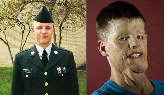 Искалеченному американскому солдату сделали новое лицо
