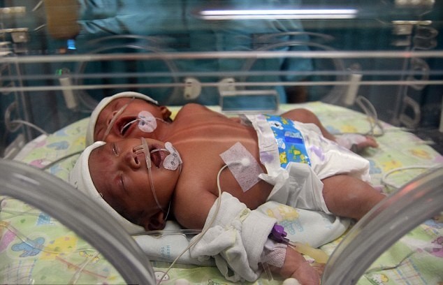 Читать В Индонезии родился двухголовый младенец