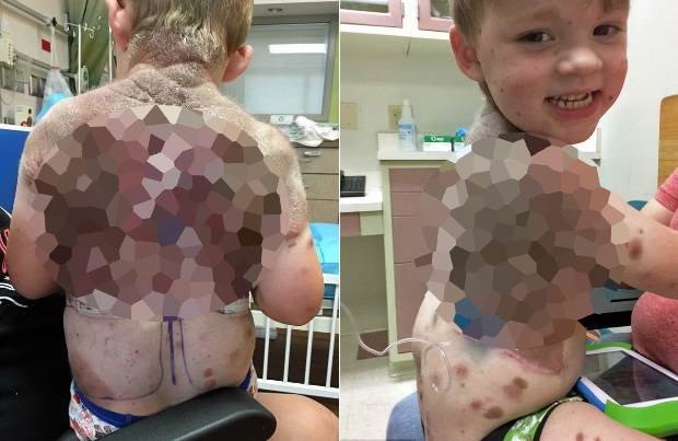 Мальчику растянули кожу имплантатом, чтобы удалить огромные родинки