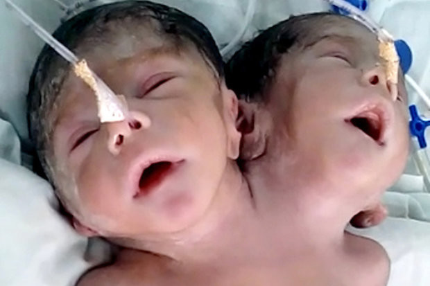 В Индии двухголовый ребенок скончался вскоре после рождения