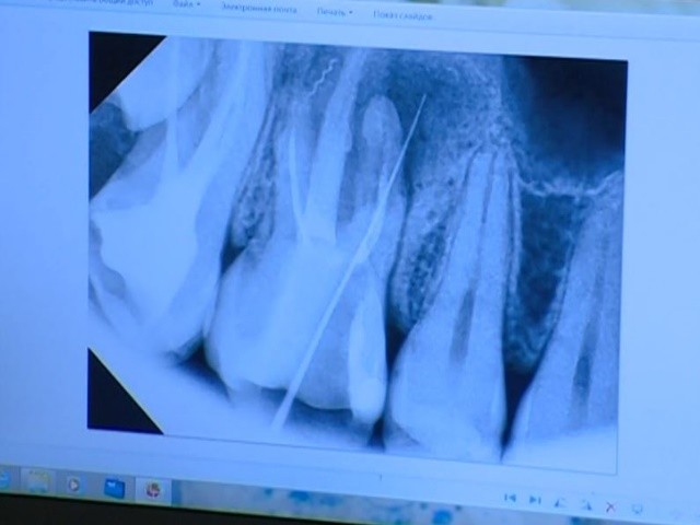 Девушка из Красноярска 10 лет ходила с забытой врачами иглой в зубе