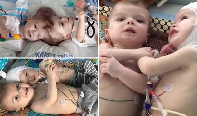 Разделенные сиамские близнецы, которые родились со сросшимися головами, два месяца после операции