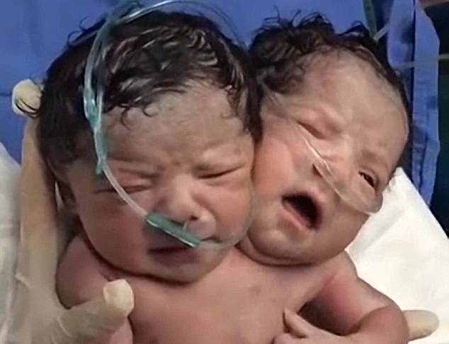 В Мексике родился двухголовый ребенок