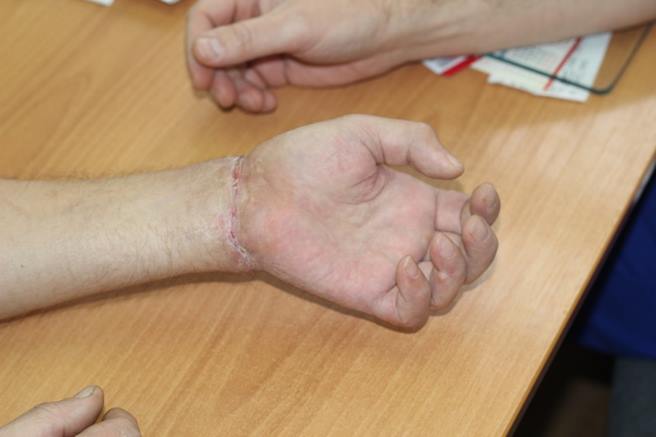 В Магнитогорске хирурги пришили мужчине оторванную кисть руки