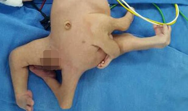 В Индии прооперировали мальчика с лишней парой рук и ног