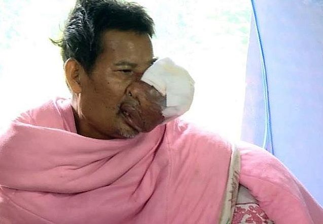 Житель Таиланда страдает от опухоли на лице, похожей на рыбу