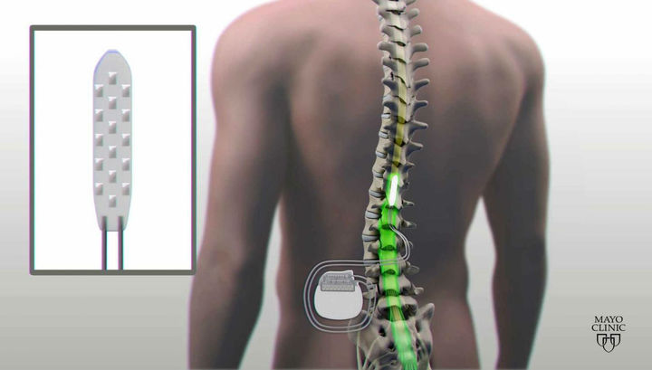 Электростимуляция спинного мозга помогла инвалиду вновь начать двигать ногами