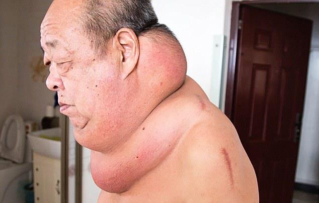 Большая толстая опухоль поразила шею китайца