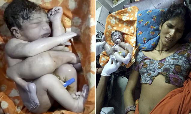В Индии родился младенец с четырьмя ногами и двумя пенисами