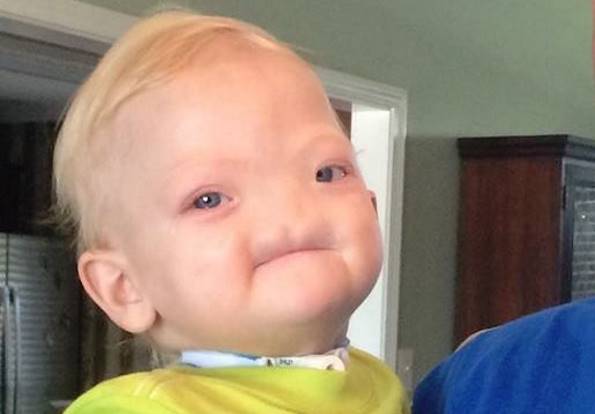 В США умер двухлетний мальчик, родившийся без носа