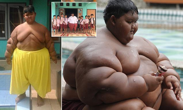 Самый толстый мальчик в мире стремительно теряет вес после операции