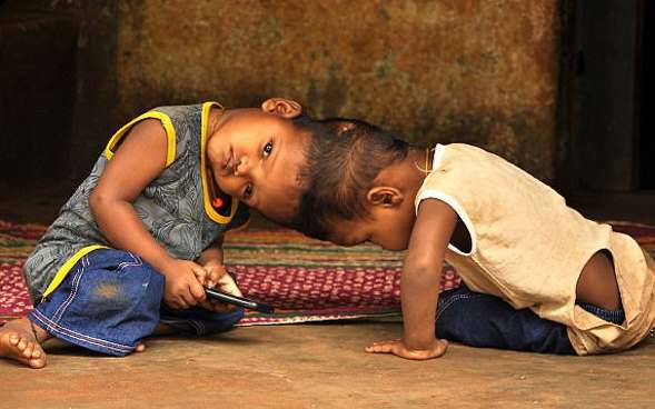 Двухлетние индийские сиамские близнецы соединены верхними частями головы