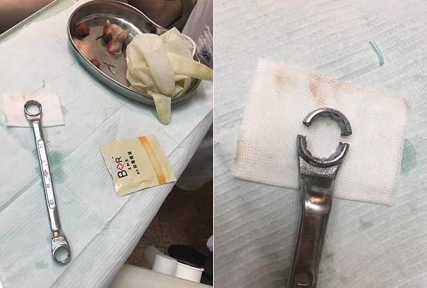 Стоматологам пришлось снимать кольцо гаечного ключа с причинного места китайца