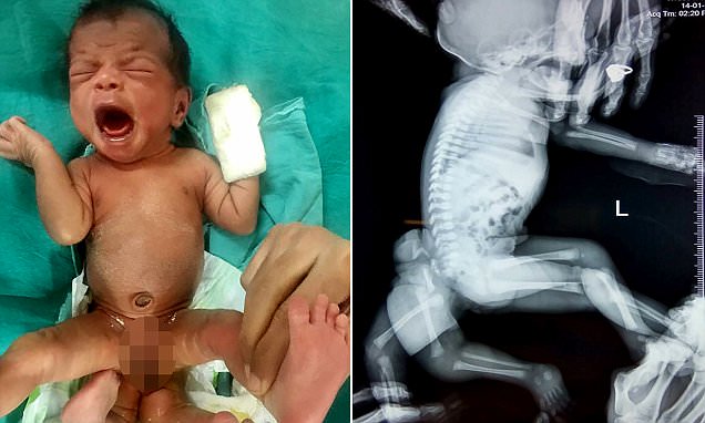 5-месячному индийскому младенцу удалили лишние ноги, растущие из ягодиц