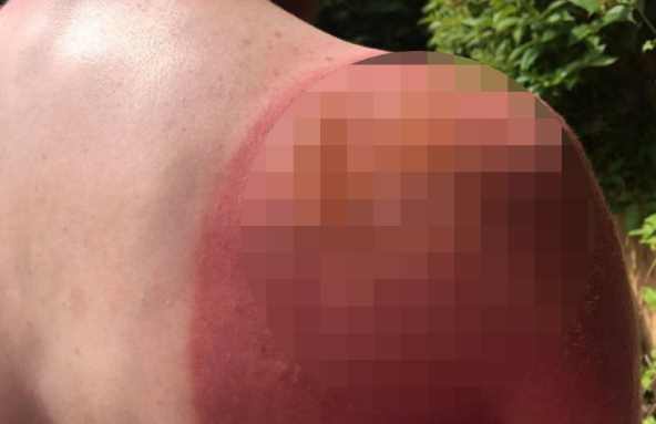 В Шотландии мужчина получил ужасные ожоги, поработав на солнце без защитного крема