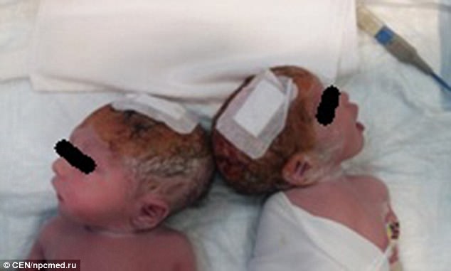 В Подмосковье хирурги разделили сиамских близнецов, которые срослись кожей на головах