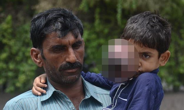 В сеть попали жуткие фото пакистанского мальчика с огромной опухолью на лице