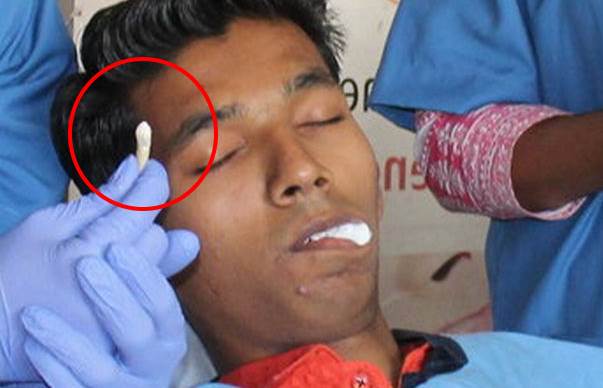 В Индии парню удалили изо рта огромный клык