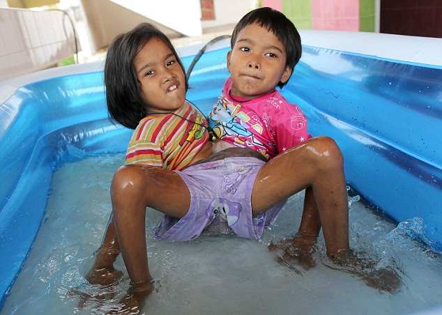 Читать Тайские 7-летние сиамские близнецы с одной на двоих нижней частью тела