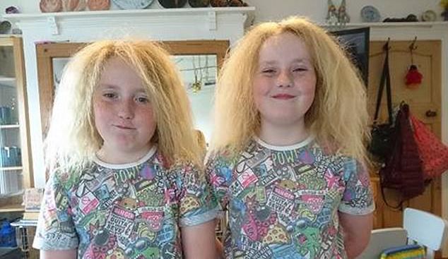 Единственные в мире близнецы с синдромом нерасчесываемых волос