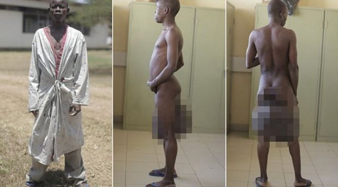 Хирурги прооперировали юношу из Кении с самой большой мошонкой в мире
