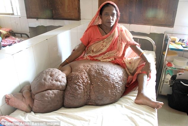 У женщины из Бангладеш распухшая из-за паразитов нога весит 60 кг