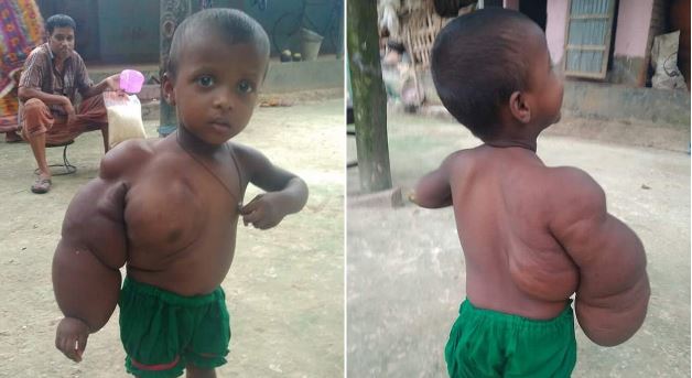 У 2-летнего мальчика из Бангладеш огромная рука
